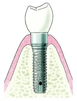 implantaatmetkroon