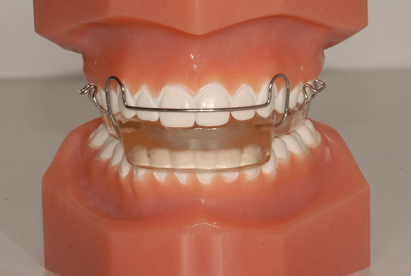 Mobiliseren lekken winter Orthodontie - Elementen mondzorg